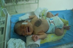 Kamar Penuh, RSUD Pekanbaru Tolak Pasien Bayi Jantung Tumbuh di Luar