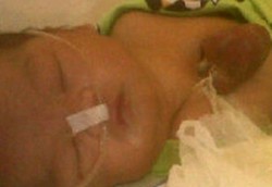 Siti Arrahma, Bayi yang Terlahir dengan Jantung di Luar Tubuh