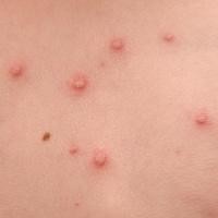 Jangan Remehkan Penyakit Cacar Air