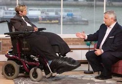 Perempuan dengan Kaki Raksasa Karena Penyakit Langka