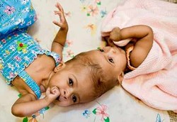 Kembar Siam dengan Kepala Menyatu Bisa Dipisahkan