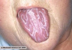 Lidah Geografik, Permukaan Lidah Seperti Gambar Pulau-pulau