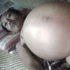 Penderita Kaki dan Kelamin Besar Dari Cacing Filaria