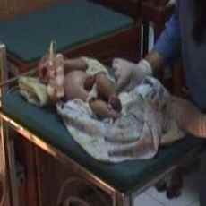 Bayi Lahir Dengan Usus Keluar di Nganjuk Kondisinya Lemah