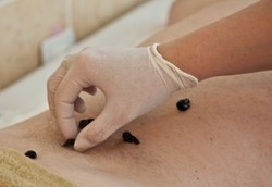 Sukses Mempermak Wajah dengan Bantuan 358 Ekor Lintah