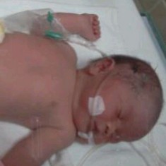 Ziva, Bayi Lahir Tanpa Anus Butuh Bantuan Rp 150 Juta untuk Operasi 