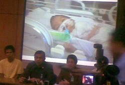 Siti Arrahma, Bayi dengan Jantung di Luar Mulai Minum ASI