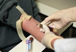 Stroke Bisa Dideteksi Melalui Tes Darah