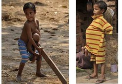 Bocah yang Terlahir dengan 8 Lengan dan Kaki