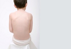 Anak Sering Garuk-garuk Pantat Adalah Gejala Cacingan