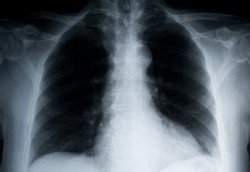 Kenapa Penyakit Paru Bikin Orang Kurus?