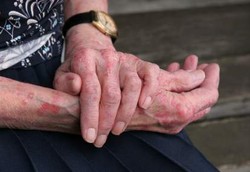 Pengobatan Rumah untuk Redakan Iritasi Kulit