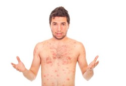 Kena Cacar Air Saat Dewasa Bisa Lebih Berbahaya