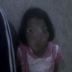 Yani Tunggu Uluran Tangan untuk Bisa Jalani Operasi