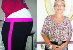 Nenek 60 Tahun Dikira Hamil Padahal Tumor Raksasa