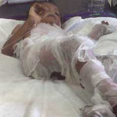 Ilham, Bocah 6 Tahun Terbakar di Rumahnya Meninggal Dunia