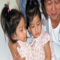 Dempet di Dada & Perut, Angelina & Angelica Berhasil Dipisahkan