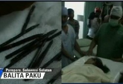 25 Paku Masuk ke Dalam Tubuh Sulit Dijelaskan Secara Medis