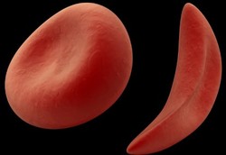 Harapan Baru untuk Pengobatan Anemia Sel Sabit