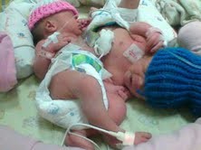 Orangtua Bayi Kembar Dempet Bekerja di Pabrik Sepatu Rumahan