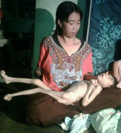 Derita Penyakit Aneh, Bocah Usia 11 Tahun Beratnya Hanya 6 Kg