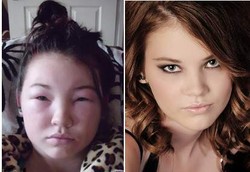 Wajah Membengkak Seperti Gajah Karena Alergi Pewarna Rambut