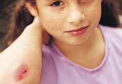 Ini Caranya Agar Luka Tak Menimbulkan Bekas