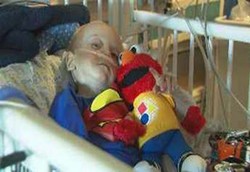 Kerongkongan Balita Terbakar Karena Menelan Baterai Lithium