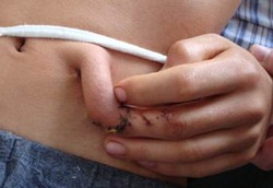 Jari Terpotong Berhasil Ditumbuhkan Lagi di Atas Perut