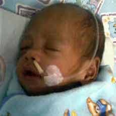 Alami Jantung Bocor, Hidup Aisyah Tergantung Selang Pernafasan