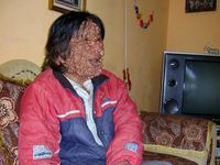 Warga Malang Derita Tumor di Seluruh Tubuh
