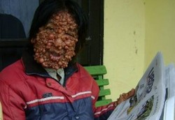 Dirut RSCM: Sulit Operasi Semua Tumor Manusia Gelembung