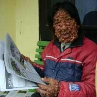 Wisnu Manusia Gelembung Diimbau Hindari Iritasi Sebabkan Infeksi