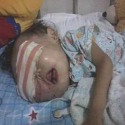 Farisa, Balita Penderita Tumor Mata Meninggal Dunia