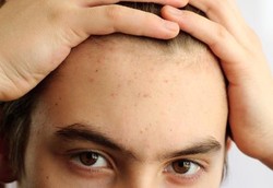 Berkeringat Saat Tidur Malam Bisa Picu Jerawat