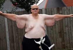 Gelambir Kulit Pada Tubuh Mantan Pria Tergemuk di Dunia