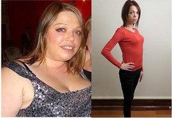 Ingin Langsing dengan Operasi Lambung Malah Jadi Kurang Gizi