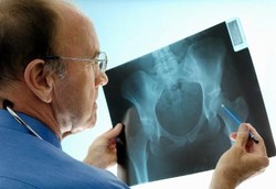 Lakukan Pencegahan Ini Sebelum Terkena Osteoporosis