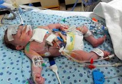 Bayi Termuda Operasi Jantung Saat Baru Berusia 22 Jam