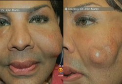 Pipi Mengeras Karena Ditambal Semen oleh Dokter Palsu