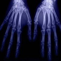 Wow, Printer 3D Bisa Cetak Tulang Buatan