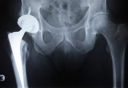 Plus Minus Implan Keramik dan Logam untuk Cedera Pinggul