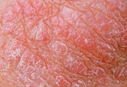 Ichthyosis Vulgaris, Kelainan Bawaan Berupa Sisik Pada Kulit