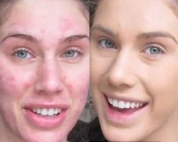 Ajaib! Model Berjerawat Buat Wajahnya Mulus Seketika