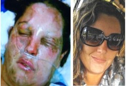 Wajah Terbakar Hebat Saat Sedang Jalani Operasi Kista di Kepala