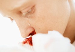 Mati Mengenaskan Cuma Gara-gara Mimisan