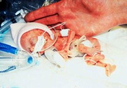 Bayi Terkecil di Dunia yang Bertahan Hidup Sampai Dewasa