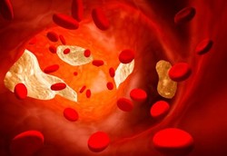 Pasien Kanker Rawat Jalan Berisiko Alami Gumpalan Darah