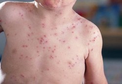 Virus Cacar Air Bisa Mati Kena Ultraviolet