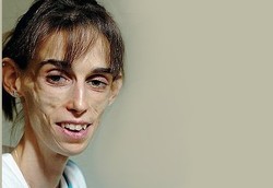 Korban Anoreksia Terparah yang Akhirnya Tak Bisa Bertahan Hidup